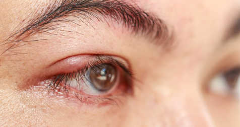 Swollen And Inflamed Eyelids, Blepharitis - Treating It With Plants